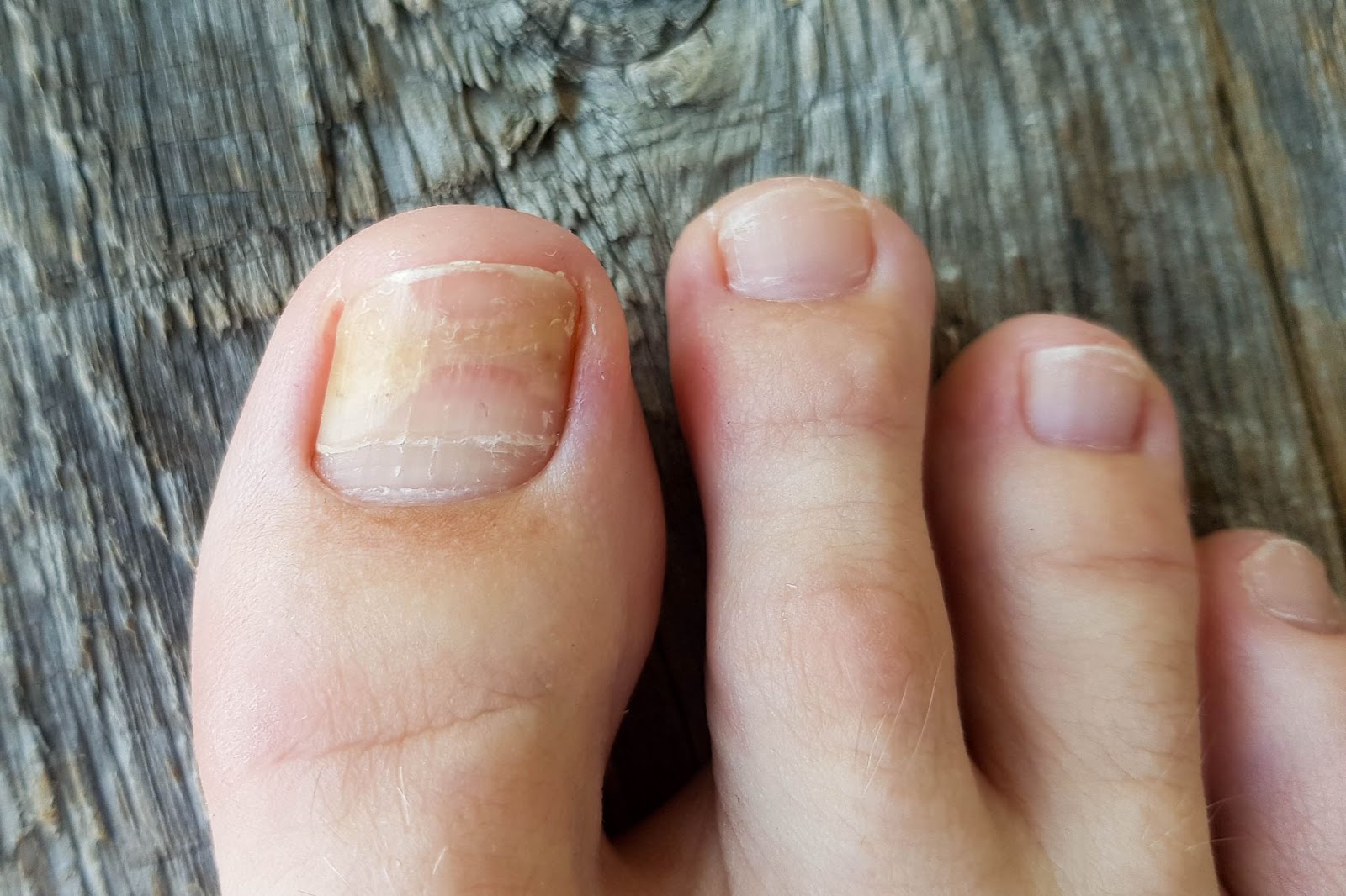 Toenail fungus causing discoloration and changes to the nail